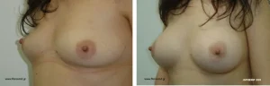Πριν & Μετά - Αυξηση Μαστων
