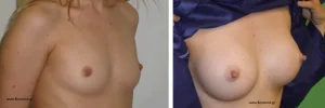 Πριν & Μετά - Αυξηση Μαστων