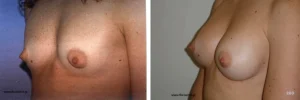 Πριν & Μετά - Αυξηση Μαστων