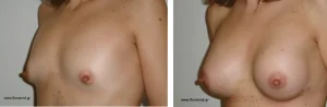 Πριν & Μετά - Αυξηση Μαστων