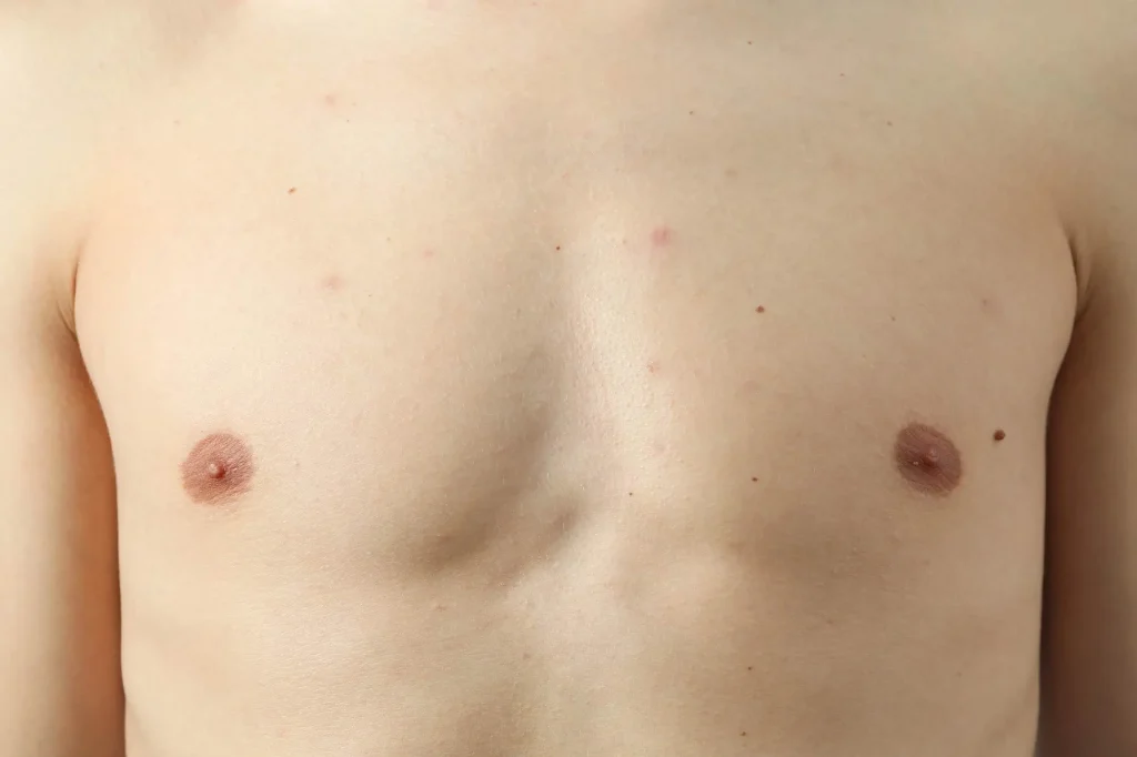 Γυναικομαστία