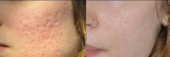 Πριν & Μετά - Ουλές Ακμής