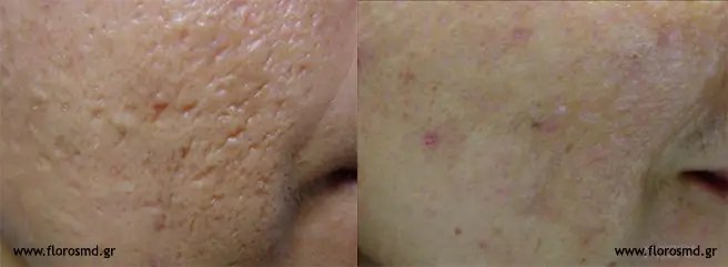 Πριν & Μετά - Ουλές Ακμής