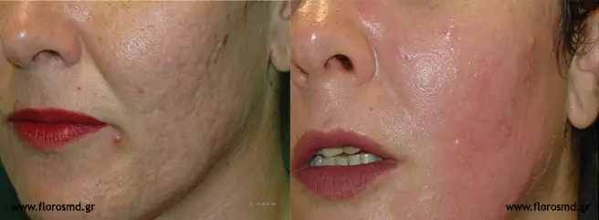 Πριν & Μετά - Ουλές Ακμής