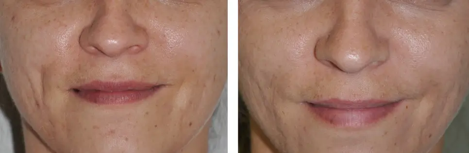 Πριν & Μετά - Ουλές Ακμής