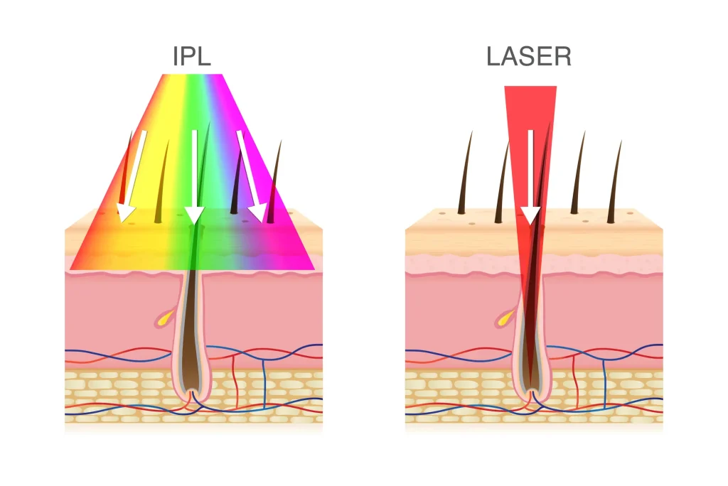 IPL (Έντονο Παλμικό Φως) σε σύγκριση με το Laser.